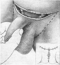 Chirurgesch Verlängerung vum Penis andeems se säi versteckten Deel erauszéien