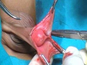 Männlech Penis Erweiderung Chirurgie